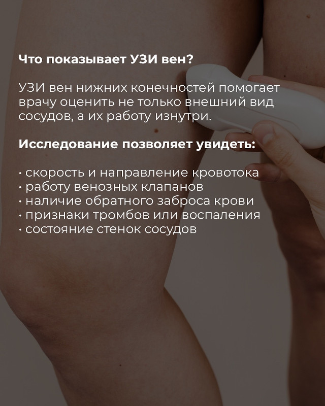 УЗИ вен