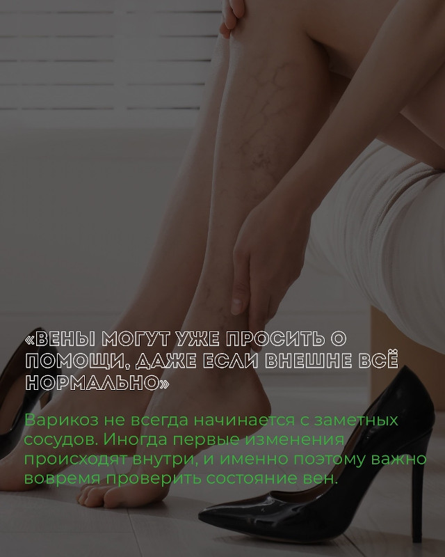 Вены могут уже просить о помощи, даже если внешне все нормально